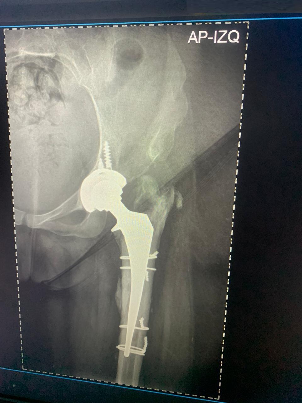 Radiografía Postoperatoria Cadera